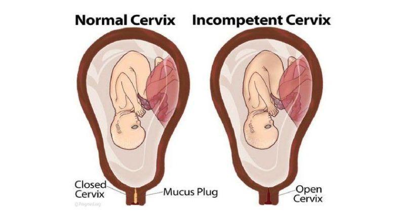 Apa itu Kandungan Lemah? Simak Penjelasan Berikut dari Dokter!